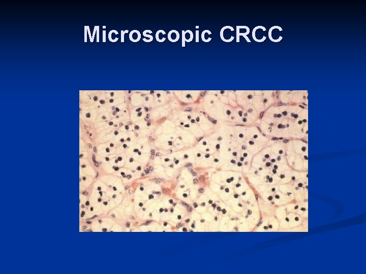 Microscopic CRCC 