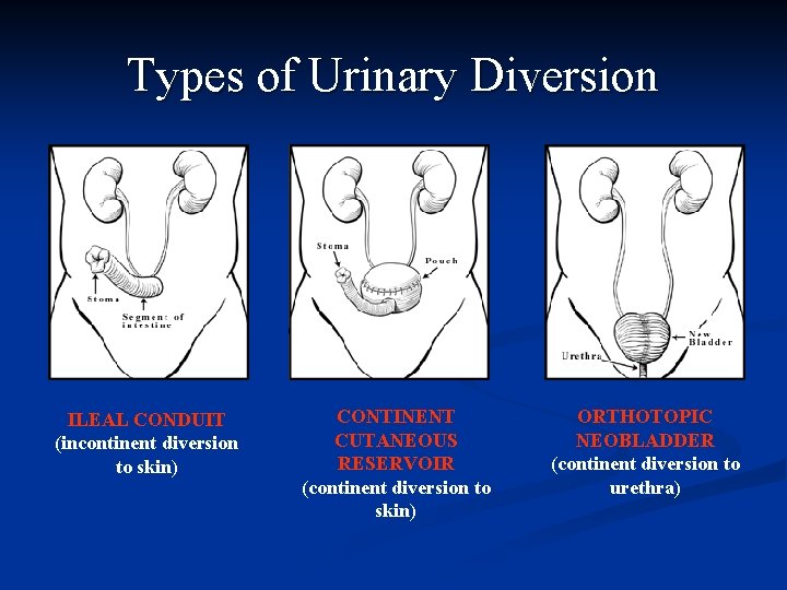 Types of Urinary Diversion ILEAL CONDUIT (incontinent diversion to skin) CONTINENT CUTANEOUS RESERVOIR (continent
