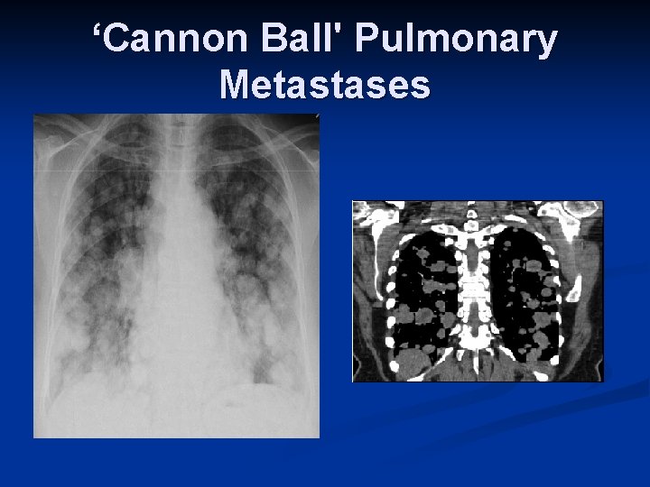 ‘Cannon Ball' Pulmonary Metastases 