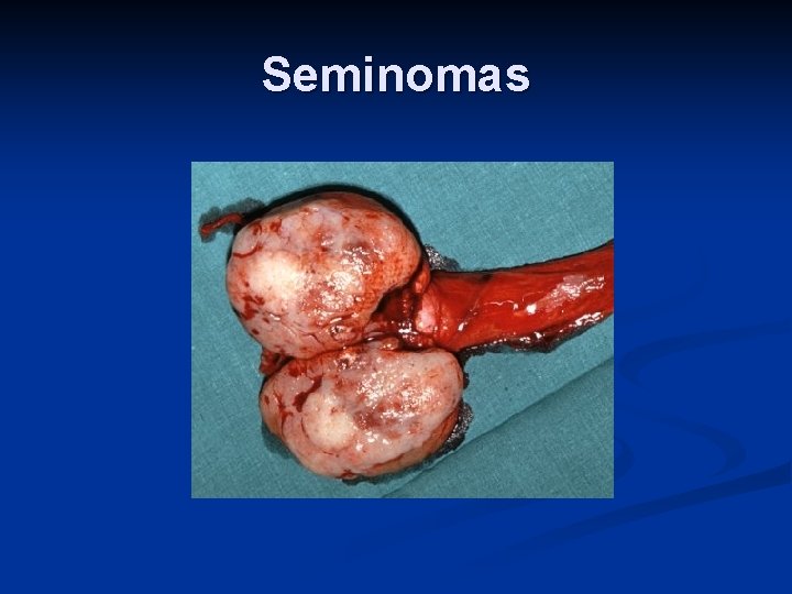 Seminomas 