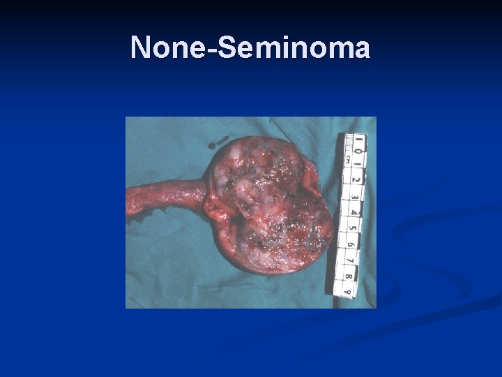 None-Seminoma 