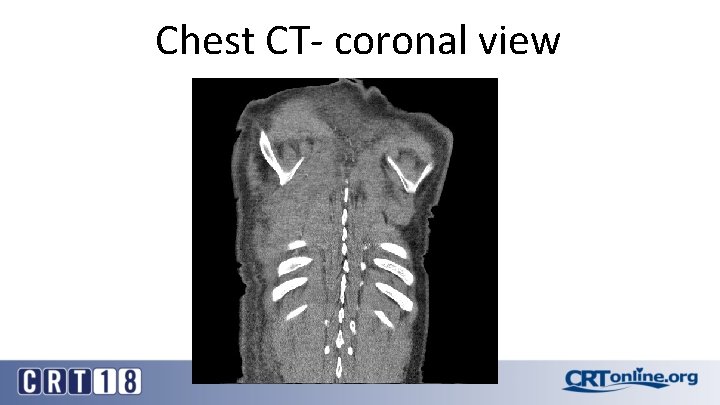 Chest CT- coronal view 