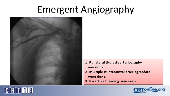Emergent Angiography 1. Rt lateral thoracic arteriography was done. 2. Multiple rt intercostal arteriographies