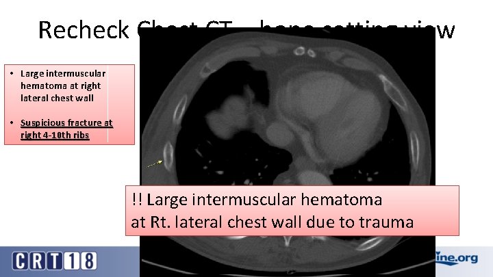 Recheck Chest CT – bone setting view • Large intermuscular hematoma at right lateral