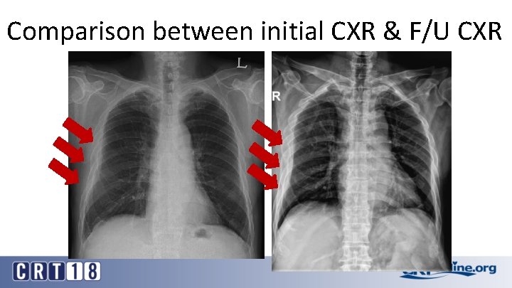 Comparison between initial CXR & F/U CXR 