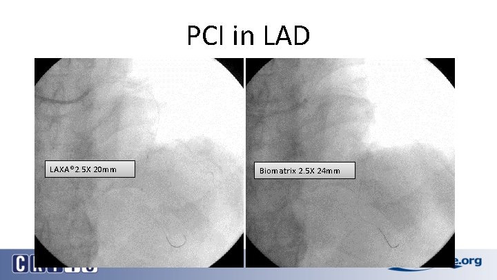 PCI in LAD LAXA® 2. 5 X 20 mm Biomatrix 2. 5 X 24
