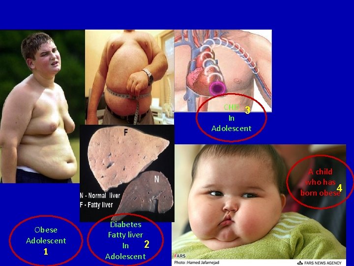 CHD 3 In Adolescent A child who has born obese 4 Obese Adolescent 1
