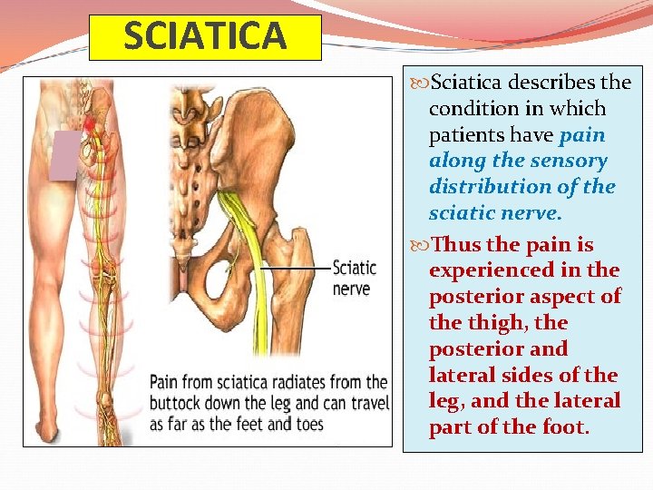 SCIATICA Sciatica describes the condition in which patients have pain along the sensory distribution