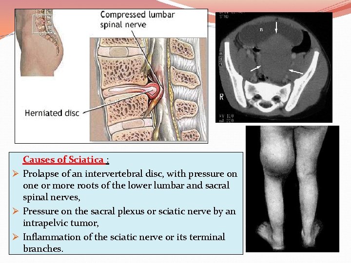 Causes of Sciatica : Ø Prolapse of an intervertebral disc, with pressure on one