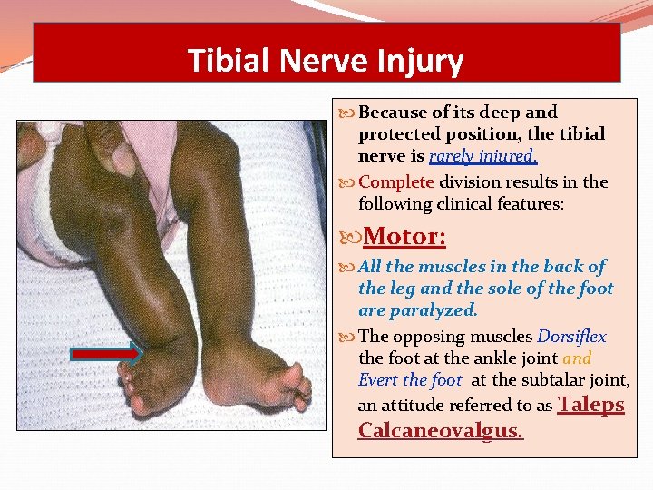 Tibial Nerve Injury Because of its deep and protected position, the tibial nerve is