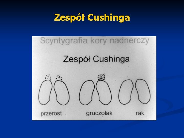 Zespół Cushinga 