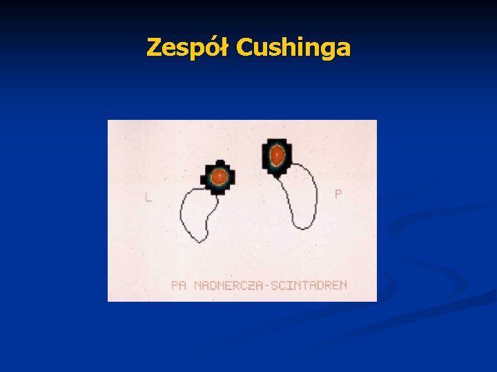 Zespół Cushinga 