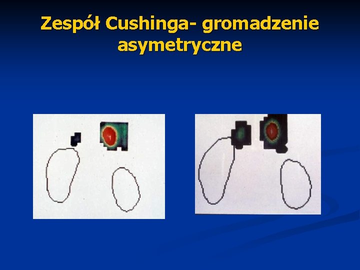 Zespół Cushinga- gromadzenie asymetryczne 