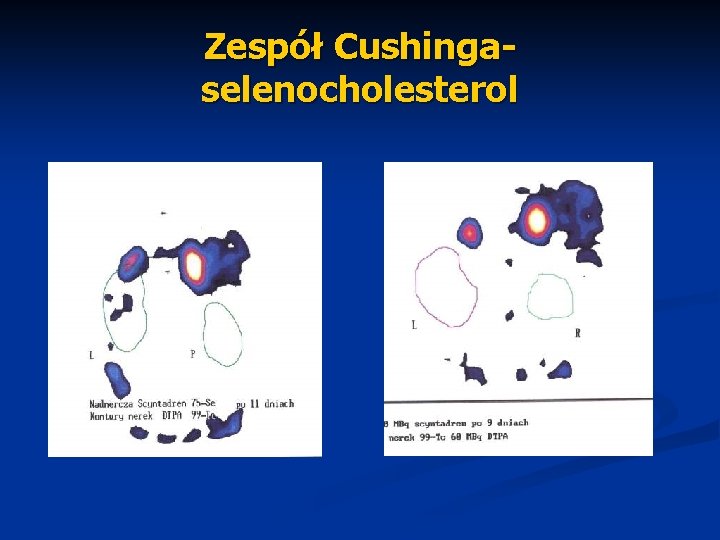 Zespół Cushingaselenocholesterol 