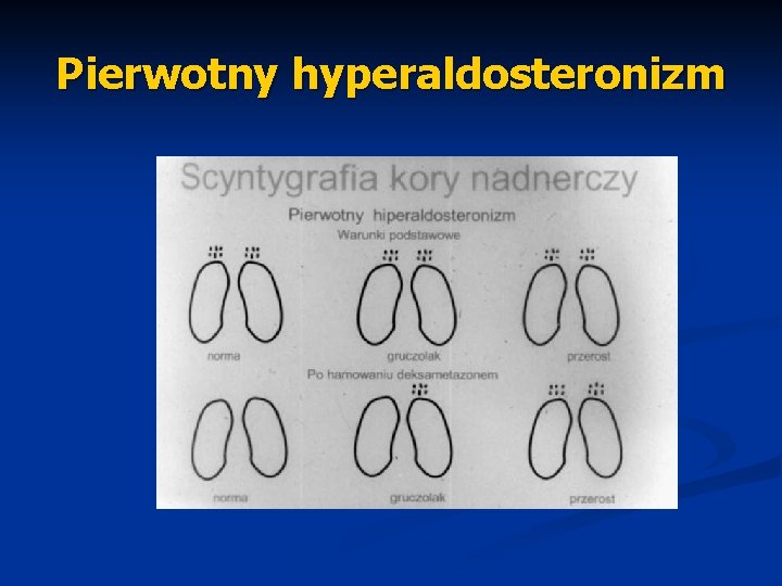 Pierwotny hyperaldosteronizm 