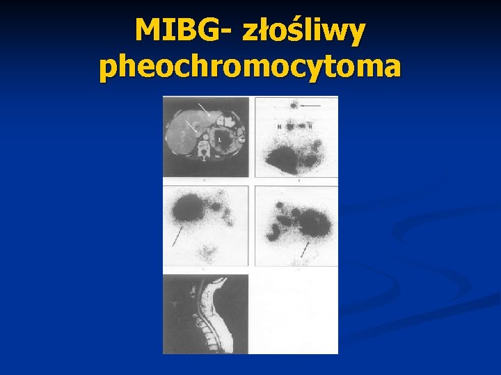 MIBG- złośliwy pheochromocytoma 