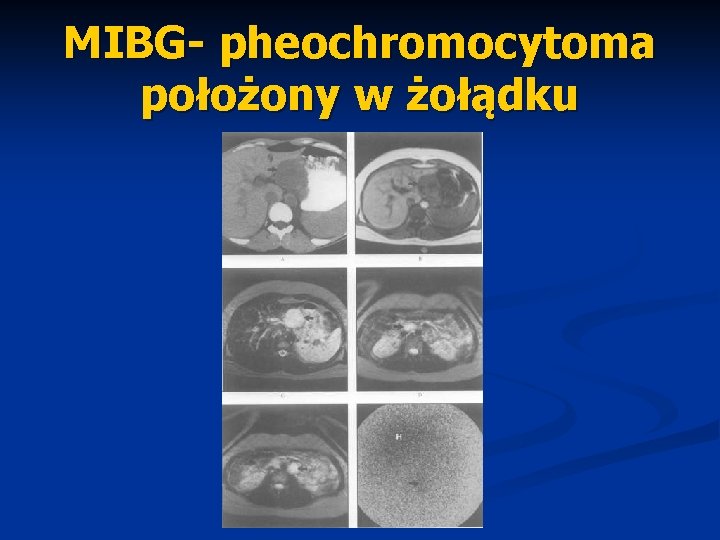 MIBG- pheochromocytoma położony w żołądku 