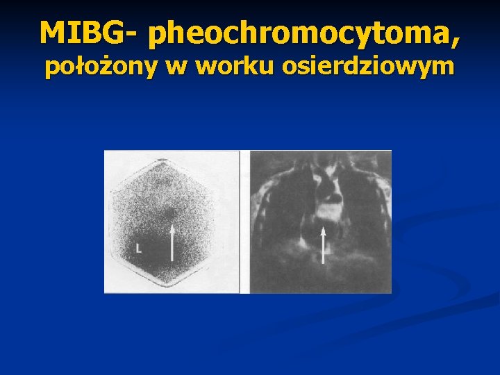 MIBG- pheochromocytoma, położony w worku osierdziowym 