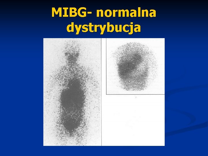 MIBG- normalna dystrybucja 