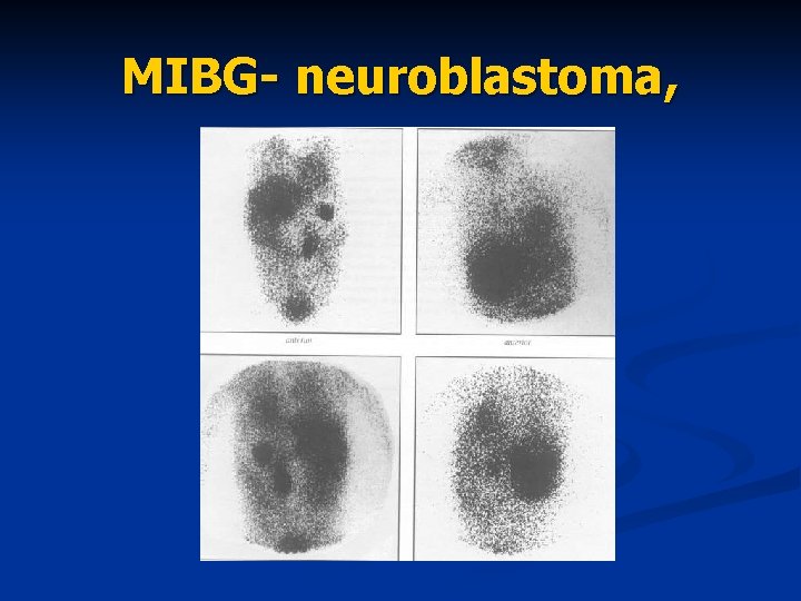 MIBG- neuroblastoma, 