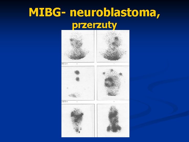 MIBG- neuroblastoma, przerzuty 