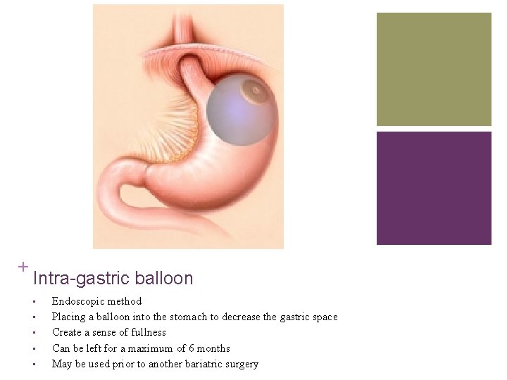 + Intra-gastric balloon • • • Endoscopic method Placing a balloon into the stomach