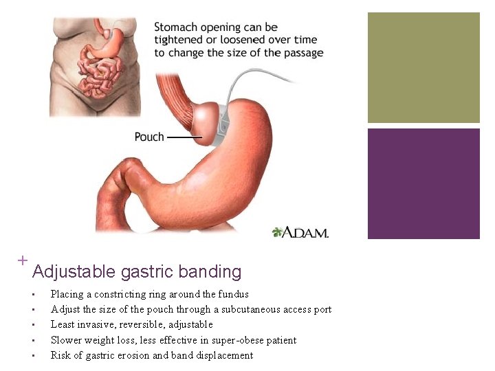 + Adjustable gastric banding • • • Placing a constricting ring around the fundus
