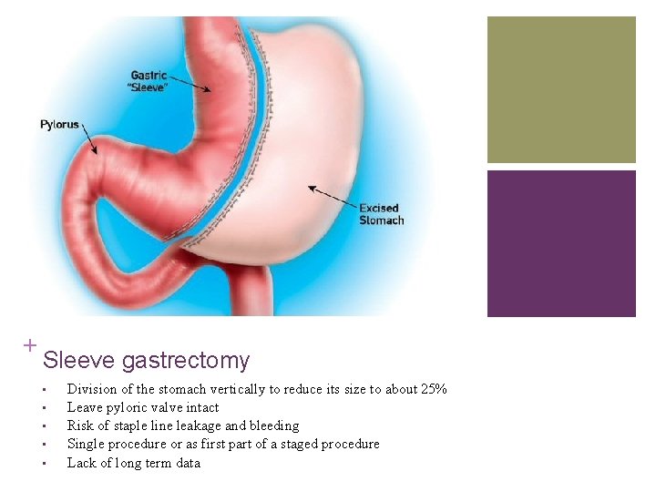 + Sleeve gastrectomy • • • Division of the stomach vertically to reduce its