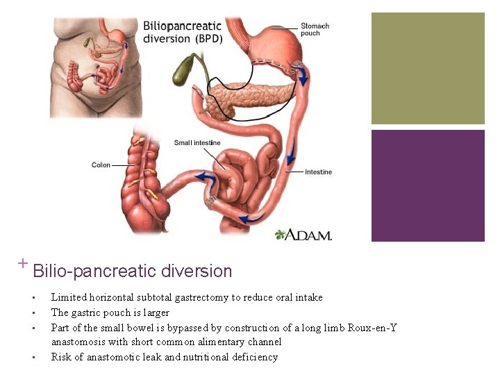 + Bilio-pancreatic diversion • • Limited horizontal subtotal gastrectomy to reduce oral intake The