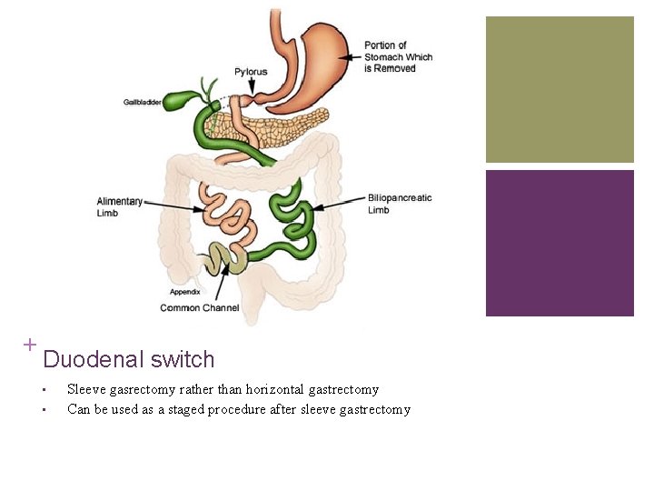 + Duodenal switch • • Sleeve gasrectomy rather than horizontal gastrectomy Can be used