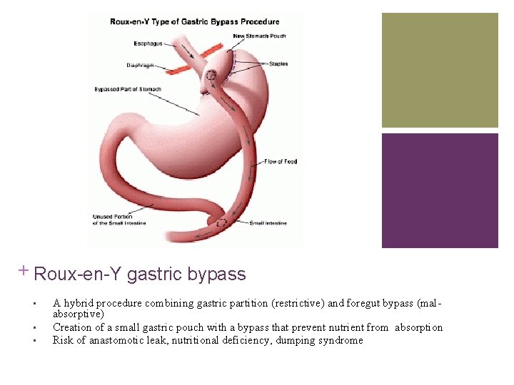 + Roux-en-Y gastric bypass • • • A hybrid procedure combining gastric partition (restrictive)