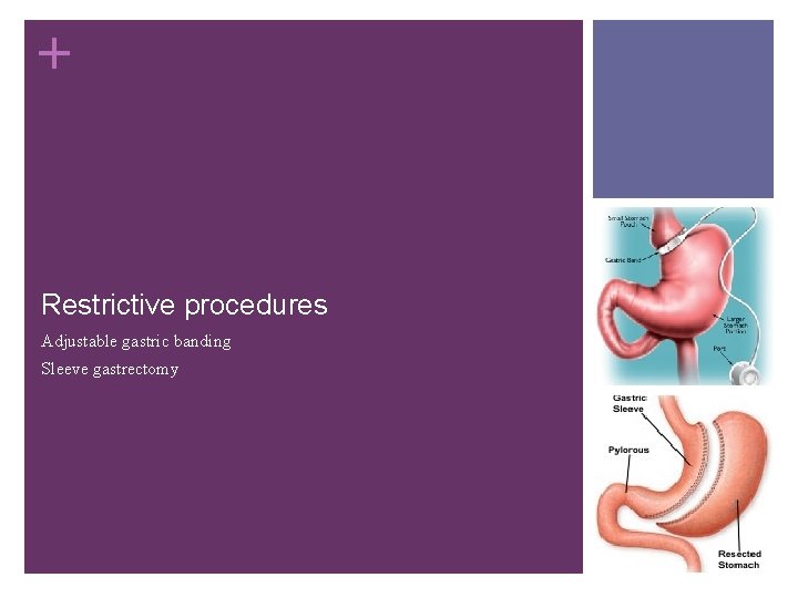 + Restrictive procedures Adjustable gastric banding Sleeve gastrectomy 