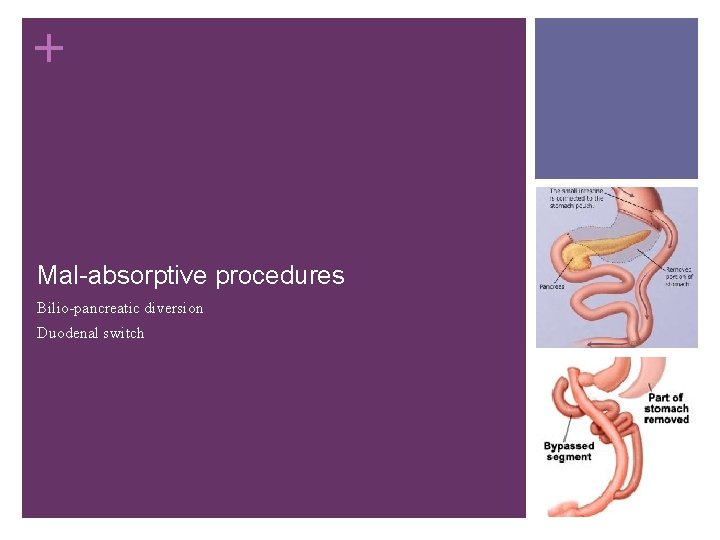 + Mal-absorptive procedures Bilio-pancreatic diversion Duodenal switch 