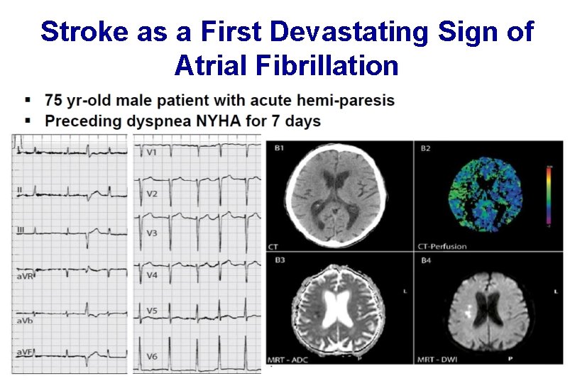 Stroke as a First Devastating Sign of Atrial Fibrillation 