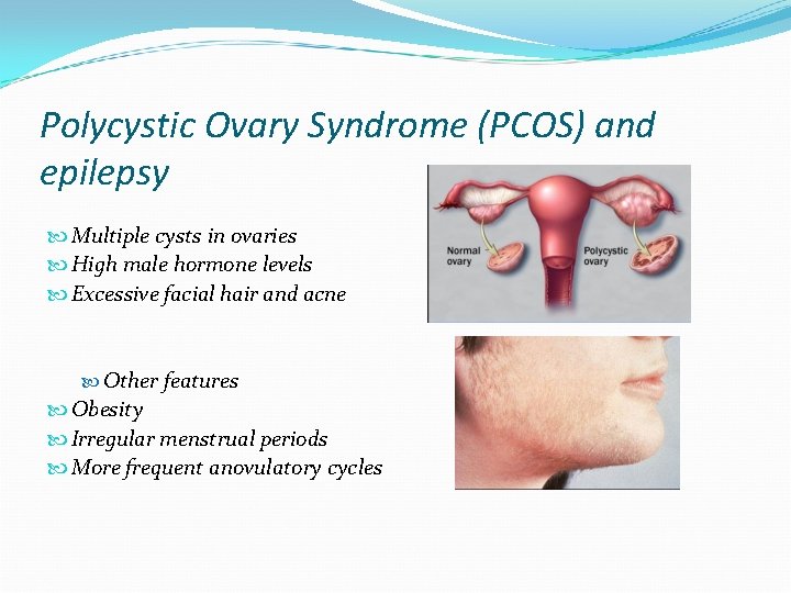 Polycystic Ovary Syndrome (PCOS) and epilepsy Multiple cysts in ovaries High male hormone levels