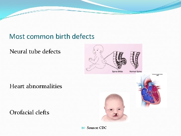 Most common birth defects Neural tube defects Heart abnormalities Orofacial clefts Source: CDC 