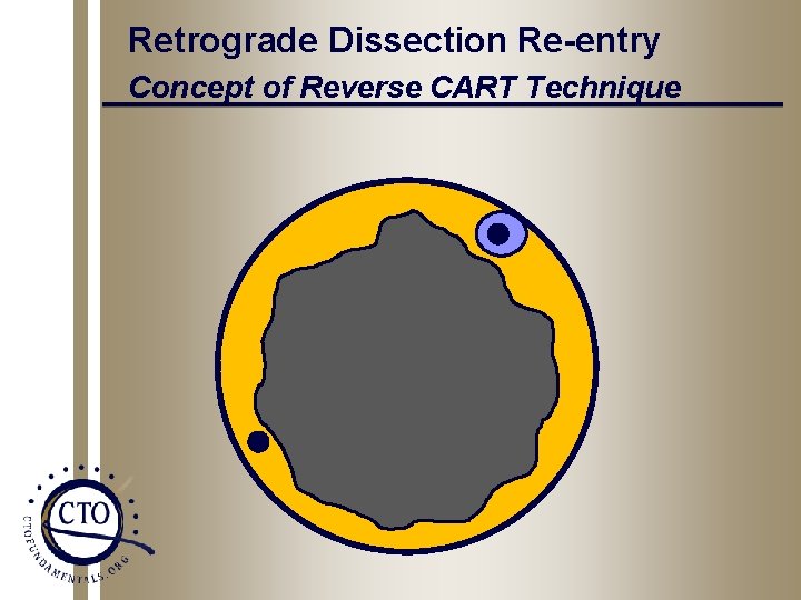 Retrograde Dissection Re-entry Concept of Reverse CART Technique 