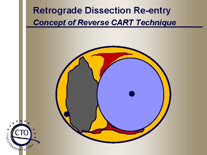 Retrograde Dissection Re-entry Concept of Reverse CART Technique 