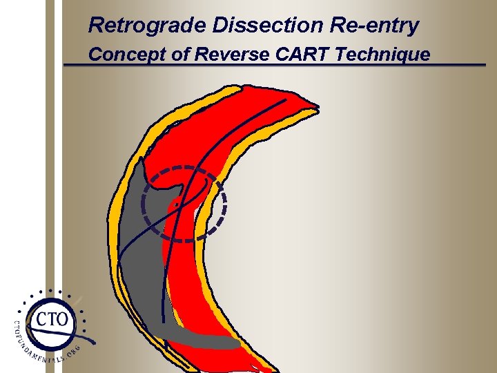 Retrograde Dissection Re-entry Concept of Reverse CART Technique 
