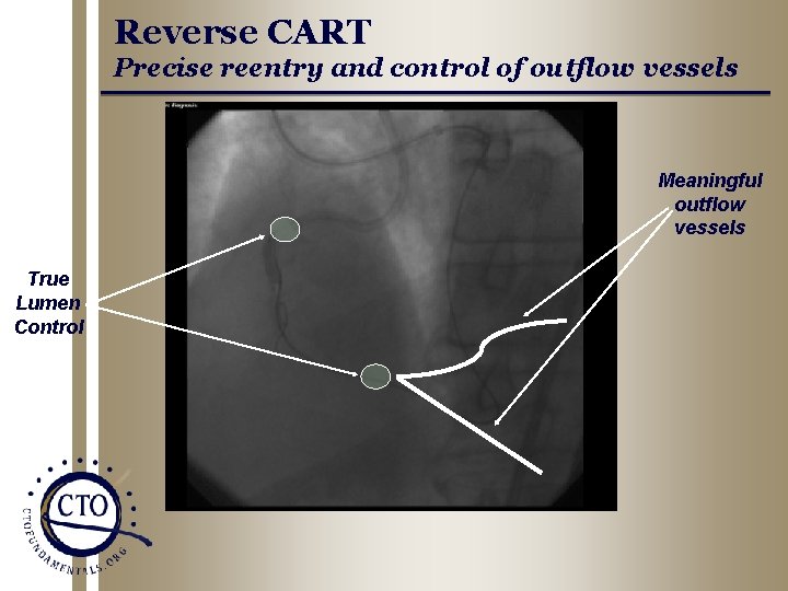 Reverse CART Precise reentry and control of outflow vessels Meaningful outflow vessels True Lumen