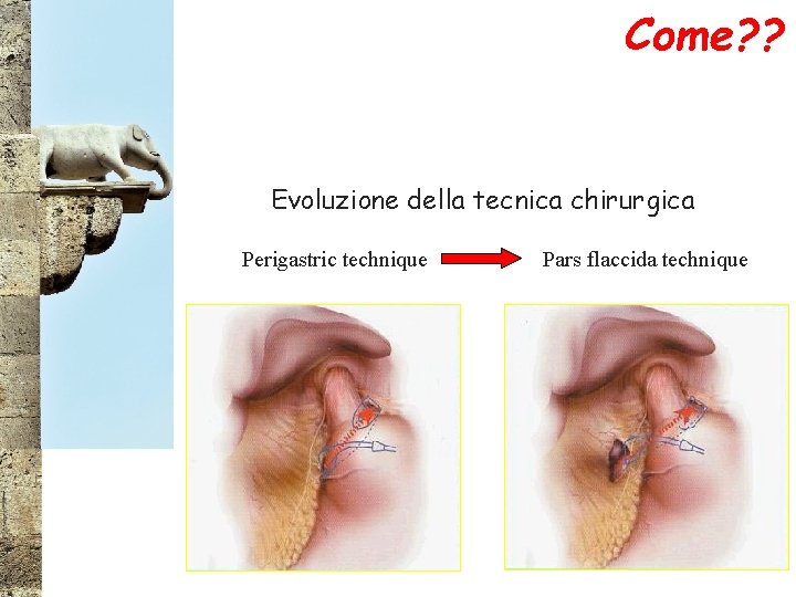 Come? ? Evoluzione della tecnica chirurgica Perigastric technique Pars flaccida technique 