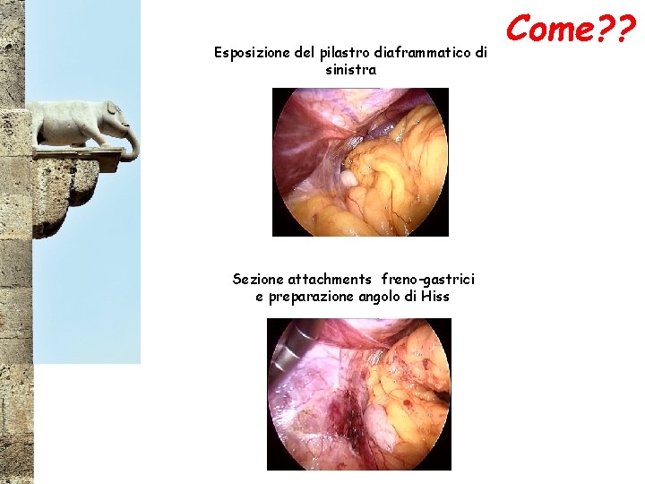 Esposizione del pilastro diaframmatico di sinistra Sezione attachments freno-gastrici e preparazione angolo di Hiss