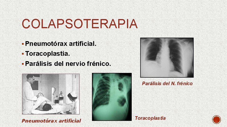 COLAPSOTERAPIA § Pneumotórax artificial. § Toracoplastia. § Parálisis del nervio frénico. Parálisis del N.