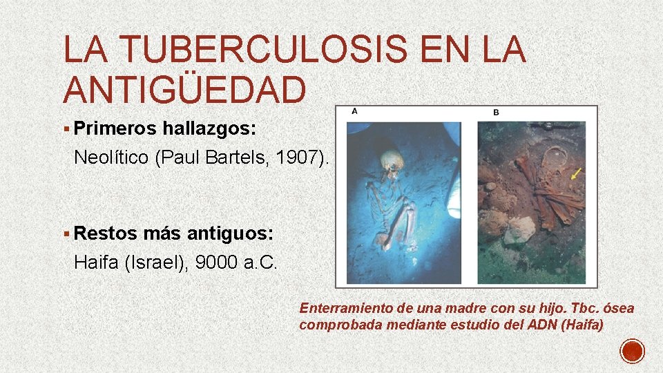 LA TUBERCULOSIS EN LA ANTIGÜEDAD § Primeros hallazgos: Neolítico (Paul Bartels, 1907). § Restos