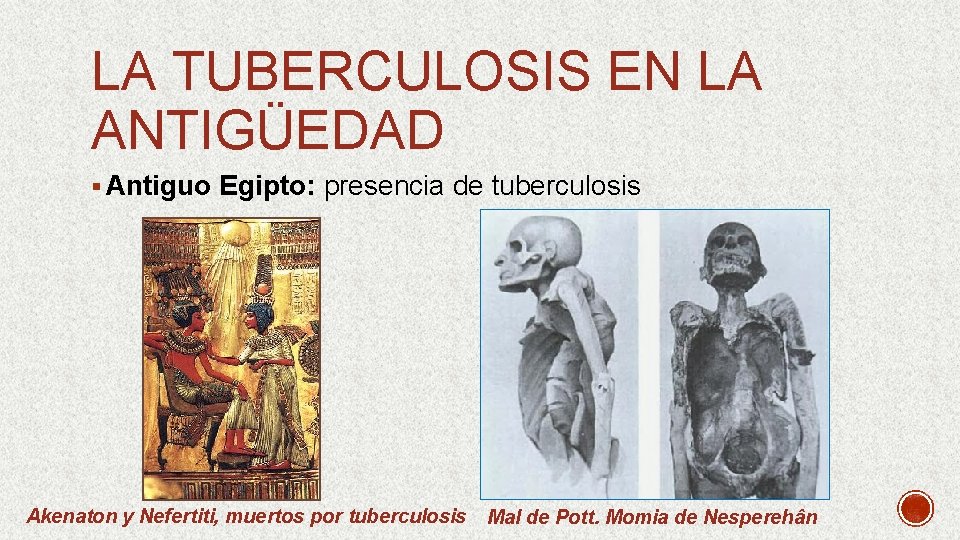 LA TUBERCULOSIS EN LA ANTIGÜEDAD § Antiguo Egipto: presencia de tuberculosis Akenaton y Nefertiti,