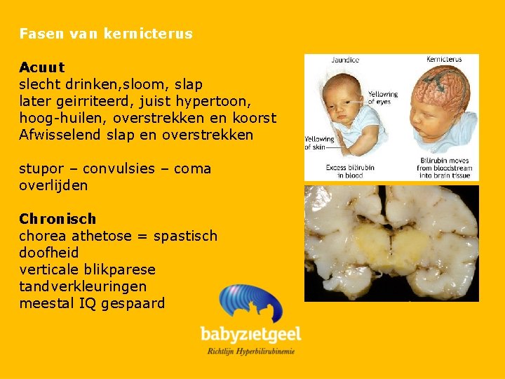 Fasen van kernicterus Acuut slecht drinken, sloom, slap later geirriteerd, juist hypertoon, hoog-huilen, overstrekken