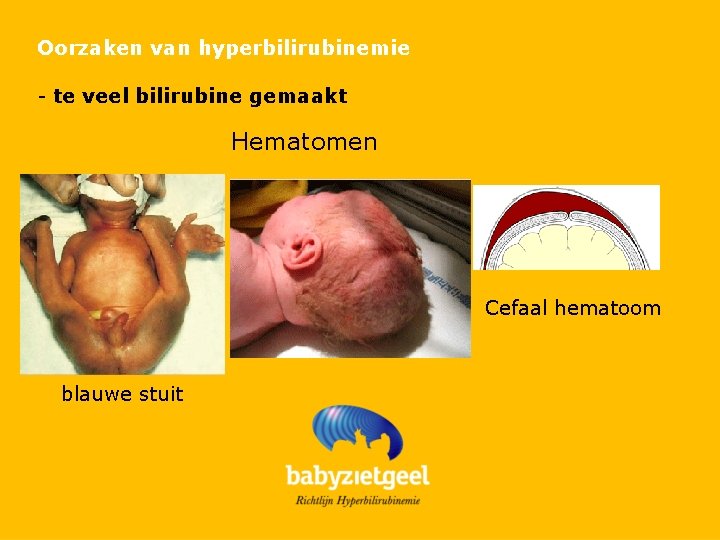 Oorzaken van hyperbilirubinemie - te veel bilirubine gemaakt Hematomen Cefaal hematoom blauwe stuit 