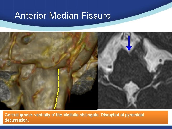 Anterior Median Fissure Central groove ventrally of the Medulla oblongata. Disrupted at pyramidal decussation.