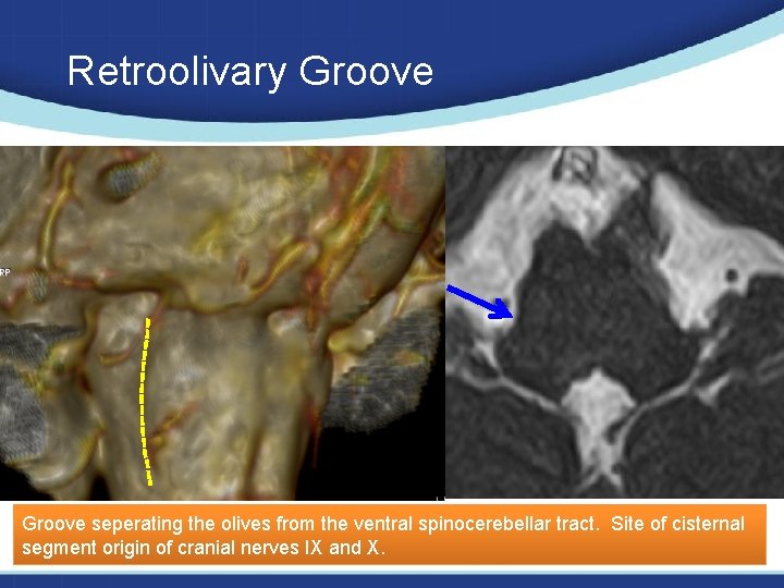 Retroolivary Groove seperating the olives from the ventral spinocerebellar tract. Site of cisternal segment