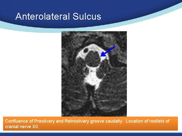 Anterolateral Sulcus Confluence of Preolivary and Retroolivary groove caudally. Location of rootlets of cranial